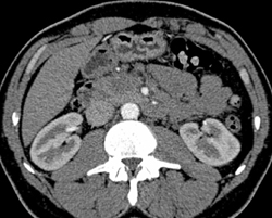 Pancreatic Cancer - CTisus CT Scan