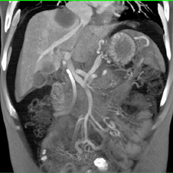 Pancreatic Cancer With Liver Metastases - CTisus CT Scan