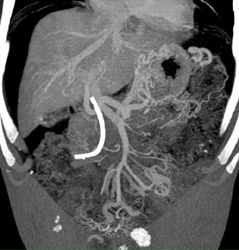 Pancreatic Cancer With Liver Metastases - CTisus CT Scan