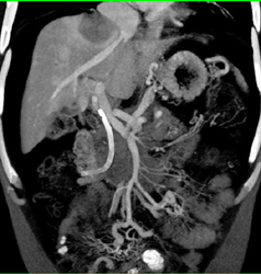 Pancreatic Cancer With Liver Metastases - CTisus CT Scan