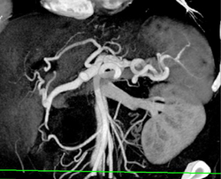 Extensive Collaterals Due to PV/SMV Invasion - CTisus CT Scan