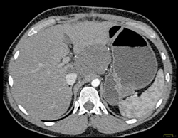 Pseudocyst - CTisus CT Scan