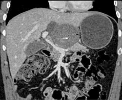 Pseudocyst - CTisus CT Scan