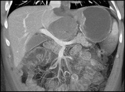 Pseudocyst - CTisus CT Scan