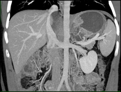 Pseudocyst - CTisus CT Scan