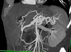 Pancreatic Cancer - CTisus CT Scan