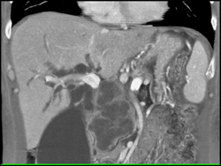 Pancreatic Cancer Encases the PV/SMV - CTisus CT Scan