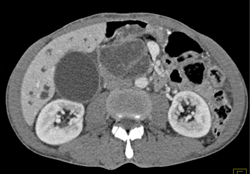 Pancreatic Cancer Encases the PV/SMV - CTisus CT Scan