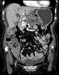 Islet Cell Tumor Encases the Portal Vein With Cavernous Transformation of the Portal Vein (CTPV) - CTisus CT Scan