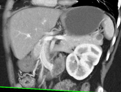 Intraductal Papillary Mucinous Neoplasm (IPMN) - CTisus CT Scan