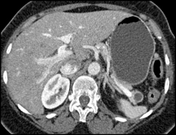 Intraductal Papillary Mucinous Neoplasm (IPMN) - CTisus CT Scan