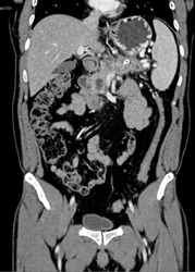 Pancreatic Cancer Encases the PV/SMV - CTisus CT Scan