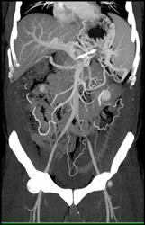 Pancreatic Cancer Encases the PV/SMV - CTisus CT Scan