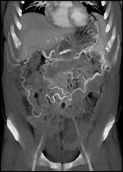 Pancreatic Cancer Encases the PV/SMV - CTisus CT Scan