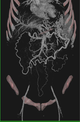 Pancreatic Cancer Encases the PV/SMV - CTisus CT Scan