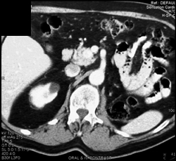 1 Cm Insulinoma in Head of Pancreas - CTisus CT Scan