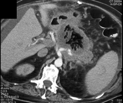 Pancreatic Abscess - CTisus CT Scan