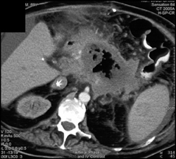 Pancreatic Abscess - CTisus CT Scan