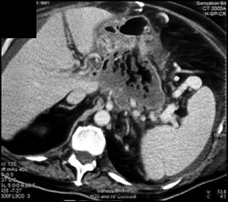 Pancreatic Abscess - CTisus CT Scan