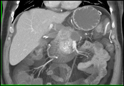 Pseudocyst - CTisus CT Scan