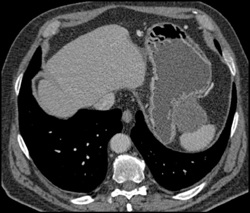 Pseudocyst Pushes on Stomach - CTisus CT Scan