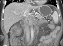 Pancreatic Cancer Encases Superior Mesenteric Vein (SMV), PV, and Superior Mesenteric Artery (SMA) With Collaterals - CTisus CT Scan