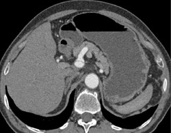 Dissection in Celiac Artery - CTisus CT Scan