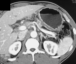 Dilated Pancreatic Duct With Pancreatitis - CTisus CT Scan