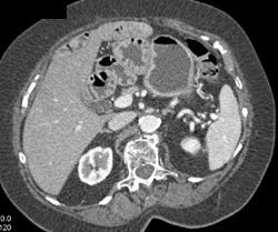 Normal Post Whipple - CTisus CT Scan