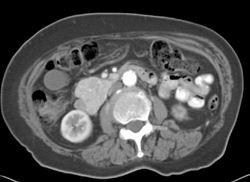 Islet Cell Tumor - CTisus CT Scan