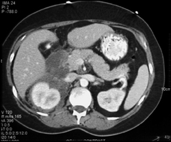 Acute Pancreatitis With Involvement of the Right Kidney - CTisus CT Scan