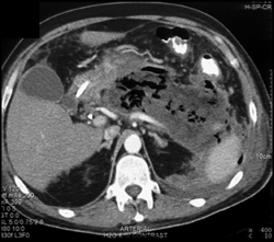 Pancreatic Abscess - CTisus CT Scan