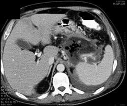 Pancreatic Abscess - CTisus CT Scan