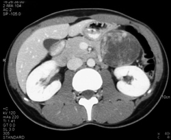 (SPEN) Solid and Papillary Epithelial Neoplasm - CTisus CT Scan