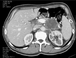 Pancreatic Carcinoma Encases the Splenic Vein and Renal Artery - CTisus CT Scan