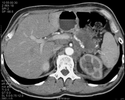 Decreased Function of Left Kidney Due to Arterial Encasement - CTisus CT Scan