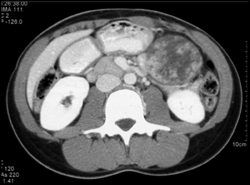 SPEN - CTisus CT Scan