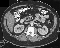 Lipoma in Head of Pancreas - CTisus CT Scan