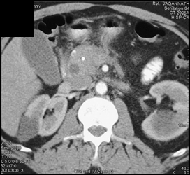 Pancreatic Cancer - CTisus CT Scan