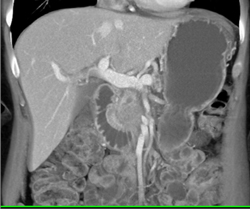 Pancreatic Cancer - CTisus CT Scan