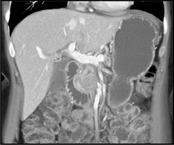 Pancreatic Cancer - CTisus CT Scan