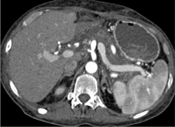 Acute Pancreatitis - CTisus CT Scan