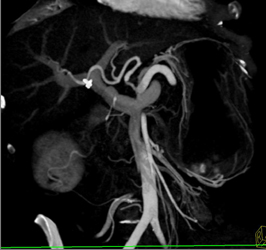 Encased Proximal Hepatic Artery - CTisus CT Scan