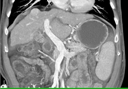 1 Cm Hepatocellular Carcinoma (HCC) in Dome of Liver - CTisus CT Scan