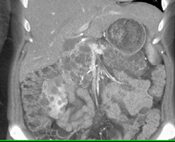 Pancreatic Cysts in Von Hippel-Lindau syndrome (VHL) With Renal Carcinoma - CTisus CT Scan