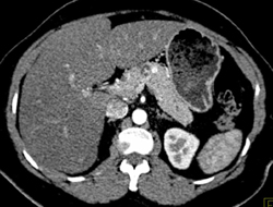 Intraductal Papillary Mucinous Neoplasm (IPMN) - CTisus CT Scan