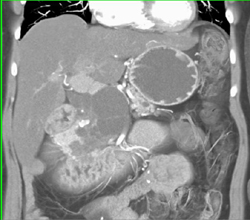 Cystadenoma - CTisus CT Scan