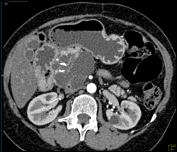 Cystadenoma - CTisus CT Scan