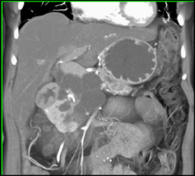 Cystadenoma - CTisus CT Scan