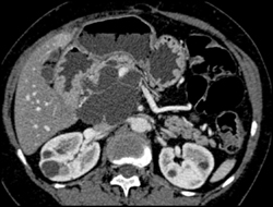 Cystadenoma - CTisus CT Scan